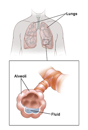 Front view of human neck and chest showing lungs. Detail of lung shows closeup view of fluid building up in alveoli.