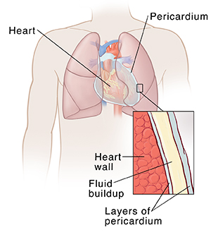 Front view of male chest showing heart and lungs with inset showing pericardium. 
