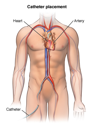 Front view of male torso showing catheter inserted in upper thigh and ending in heart.