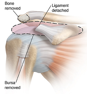 Front view of shoulder joint showing inflamed bursa and bone spur on acromion being removed.
