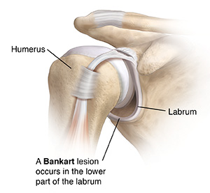 Front view of shoulder joint showing SLAP tear and Bankart tear.