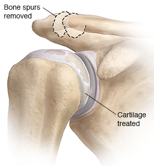 Front view of shoulder joint showing smoothed cartilage and bone spurs removed.