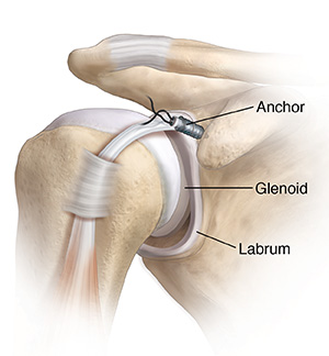 Front view of shoulder joint showing tears at top and bottom of labrum. Anchors are being placed to repair tears.