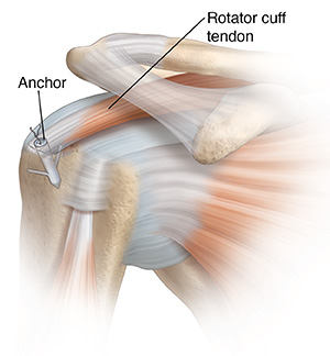 Front view of shoulder joint with anchor repairing torn tendon.