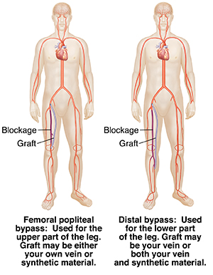 Front view of two male figures showing distal bypass graft and femoral popliteal bypass.