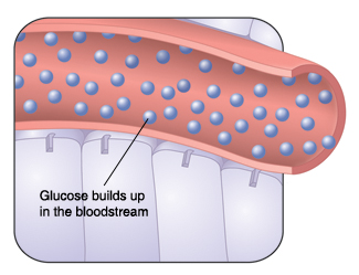 Cross section of blood vessel and cells showing glucose building up in bloodstream.