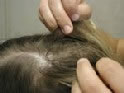 Head Lice - Searching Hair