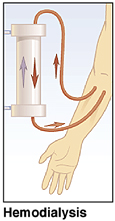 Hemodialysis