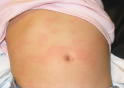 Hives on the Abdomen