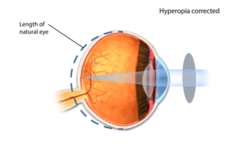 Hyperopia