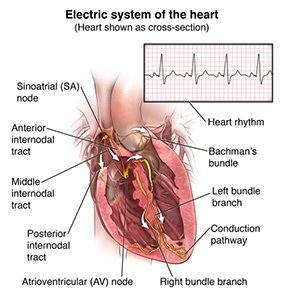 Illustration of a cross section of the heart and electrical pathways. Inset box shows normal heart rhythm