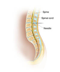 Illustration of epidural insertion