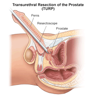 Side view of male pelvis showing transurethral resection of the prostate.