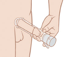 A vacuum pump draws blood into the penis, causing an erection. Man putting vacuum pump on penis.
