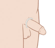 A tension ring keeps blood from flowing out of the erect penis. Tension ring around base of penis.
