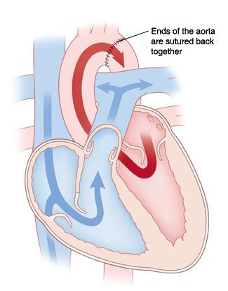 Cross section of heart showing repair of coarctation of the aorta.