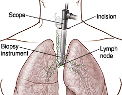 Front view of chest showing scope inserted into chest through incision.