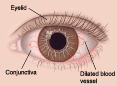 Front view of eye showing conjunctivitis.