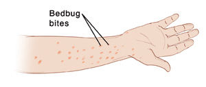 Forearm showing bedbug bites.