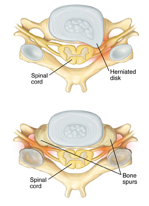 Top image is of a herniated disk and lower image is of bone spurs