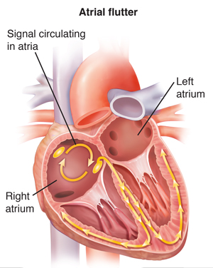 Cross section of heart showing atrial flutter.