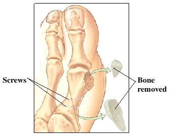 Big toe joint with bone removed and scews
