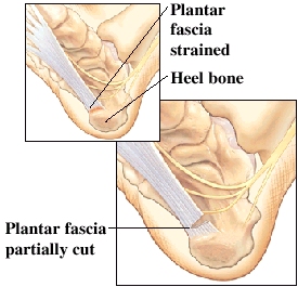 Image of strained plantar fascia