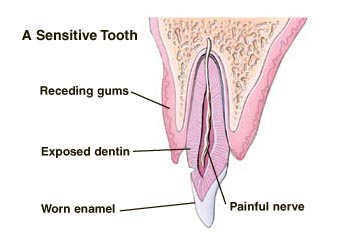 A sensitive tooth, showing receding gums, exposed dentin, worn enamel, and painful nerve