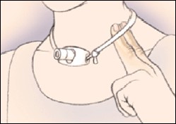 Closeup of neck with trach tube and two fingers under ties.