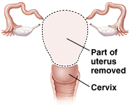 Front view of supracervical hysterectomy showing part of the uterus removed with cervix intact.