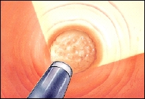 Image of a ureteroscope