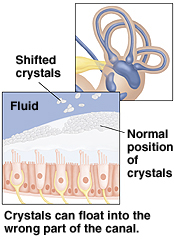 Ear canal showing closeup of fluid, normal crystals and crystals floating in the wrong part of the canal.