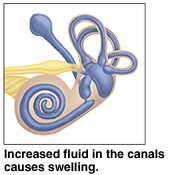 Ear canal showing increased fluid and swelling.