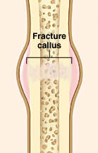 Broken bone showing callus forming at break.