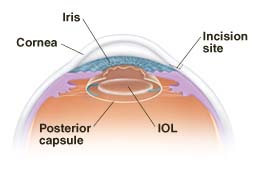 Cross section of front part of eye showing posterior capsule IOL.