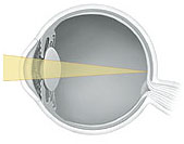 Cross section of eye showing light focusing on retina.