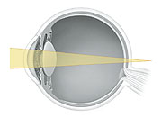 Cross section of eye showing light focusing behind retina.