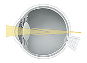 Cross section of eye showing light focusing in more than one place.