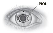 Front view of eye showing position of PIOL behind iris.