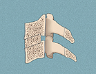 A bone graft is inserted to plug the opening.