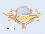 Area where lamina may be removed.