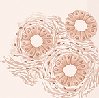 Illustration showing abnormal cells that still appear as rings in grade 1 or 2 of prostate cancer