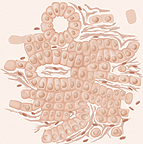 Illustration showing abnormal cells that vary in size and shape with fewer rings in grade 3 of prostate cancer