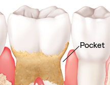 Teeth in gums showing advanced periodontitis.