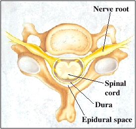 Top view of cervical vertebra showing spinal cord, dura, and epidural space.
