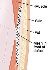 Cross section of abdominal wall showing mesh repair in front of hernia defect.