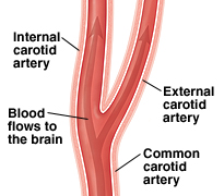 Healthy carotid artery.