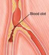 Cross section of peripheral artery blocked by plaque and blood clot.