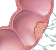 Cross section of colon and lymph nodes showing cancer spreading through wall of colon but not to lymph nodes.