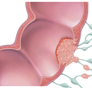 Cross section of colon and lymph nodes showing cancer spreading through wall of colon and to lymph nodes.